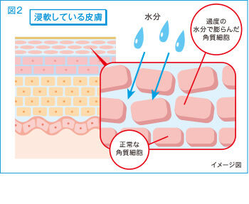 図2 浸軟している皮膚