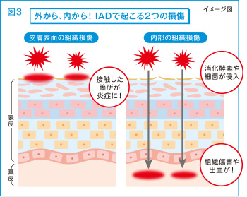 図3 外から、内からIADで起こる2つの損傷！