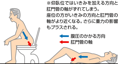 ※仰臥位ではいきみを加える方向と肛門管の軸がずれてしまう。座位の方がいきみの方向と肛門管の軸がより近くなる。さらに重力の影響もプラスされる。 腹圧のかかる方向 肛門管の軸