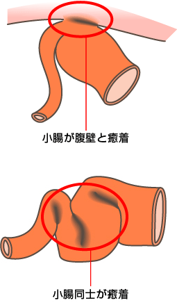 小腸が腹壁と癒着 小腸同士が癒着