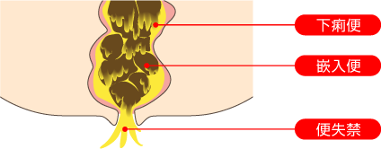 高齢者に多く見られる嵌入便 下剤の効果と問題点 下剤に頼らない排便ケア 排便ケア 排泄ケア 実践編 排泄ケアナビ ユニ チャーム